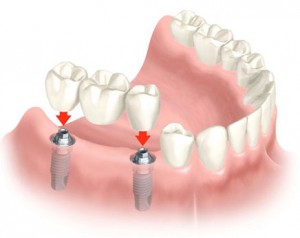 Протезирование зубов на имплантах. Протезирование в Сумах
