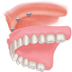 Зубные имплантаты и съемные протезы