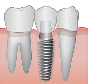 implant