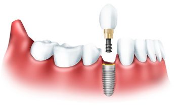 Дентальная имплантация