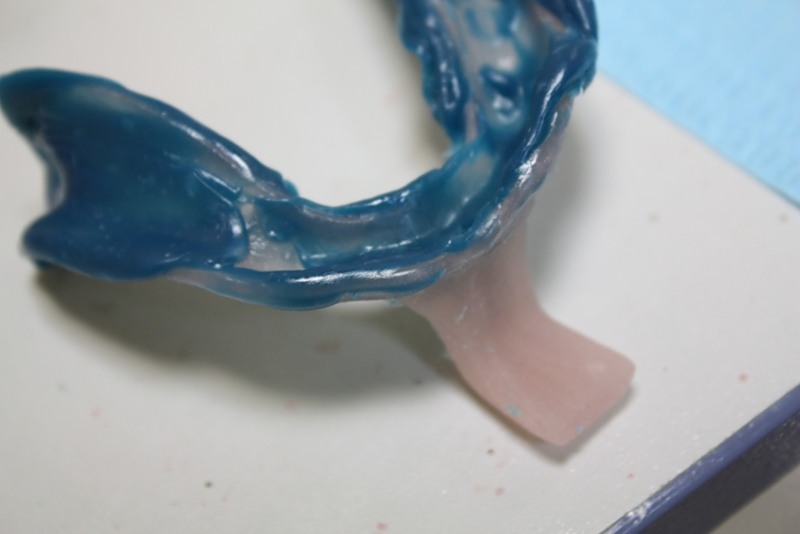 Методика изготовления индивидуальной ложки без использования стоматологической кюветы