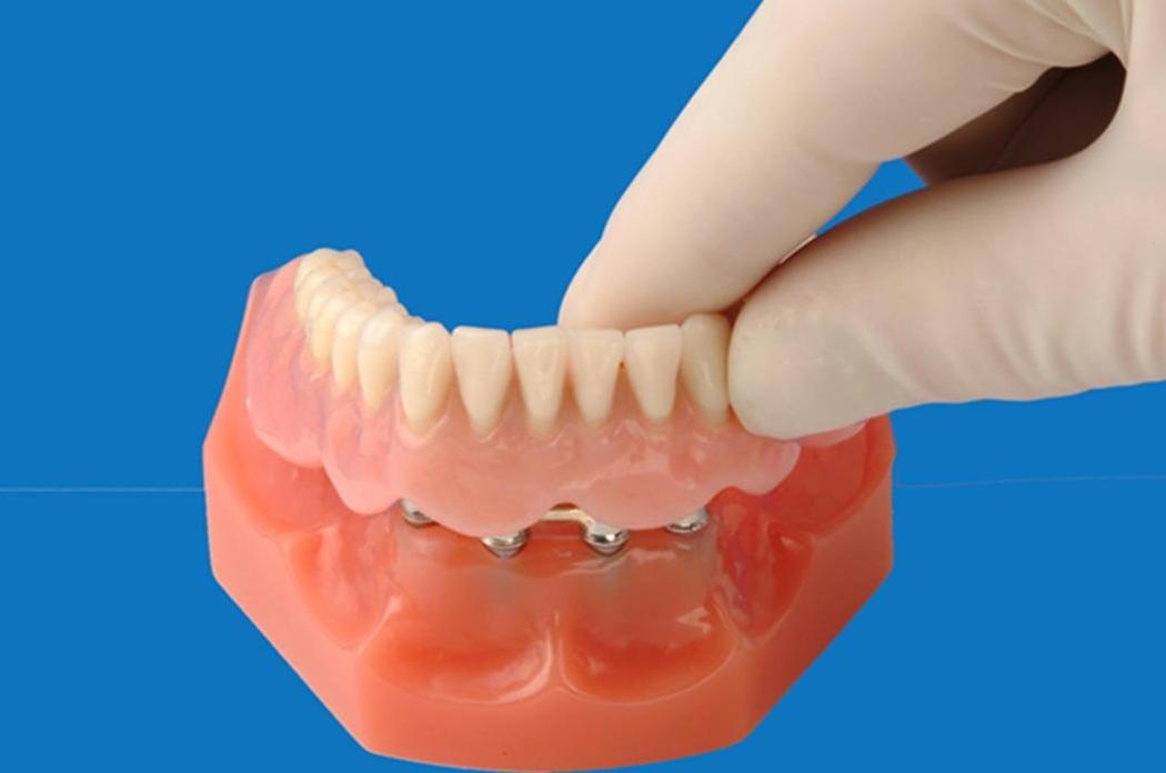 Методы изготовления протезов. Несъёмный мостовидный протез челюсти. Съемный пластиночный протез этапы. Съемный протез (3-5 зубов) термо Джет. Пластиночные зубные протезы.