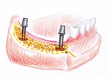 Одноэтапная имплантация зубов